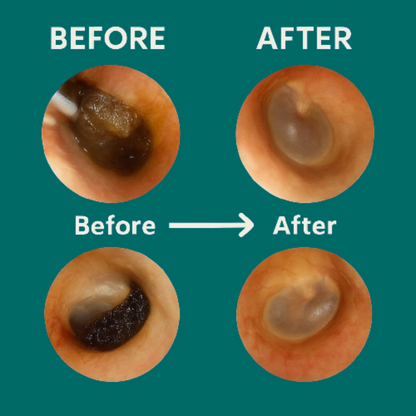 Stravax™ Ear wax Remover Kit